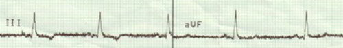 Symbolbild Krankheit (EKG)